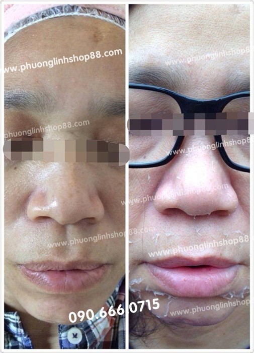Kem Vỗ Bong Da Mặt-Thay Trắng Da - Cứu Tinh Cho Da Ngăm Đen, Da Nám,Da Tàn Nhang,Da Mụn... - 32