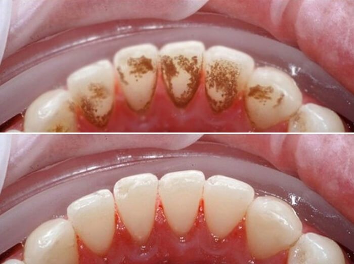 Nước xịt thơm miệng AP24 giúp làm sạch dần mảng bám trên răng