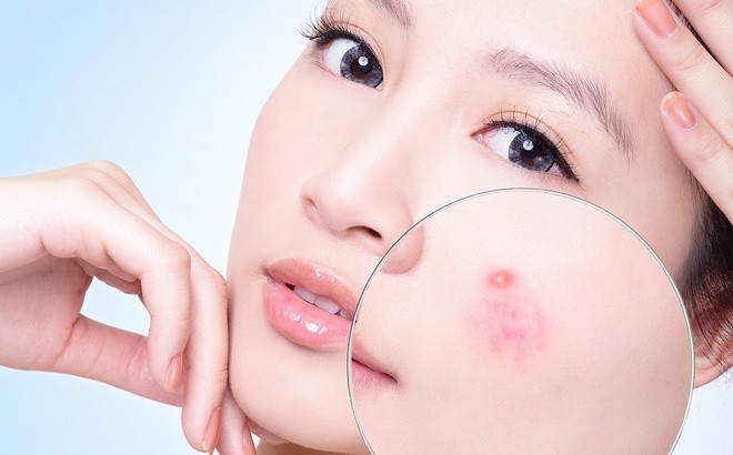 epoch-blemish-treatment-001