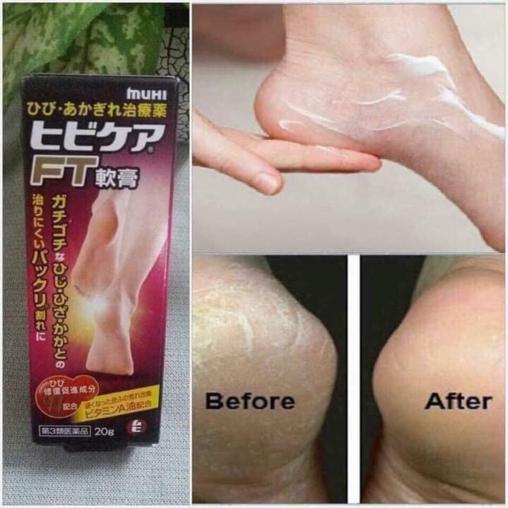 Kem trị nứt gót chân muhi Nhật Bản