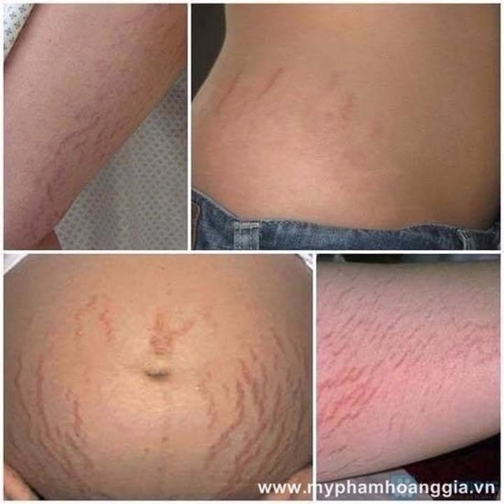 KEM TRỊ SẸO KLIRVIN NGA 2
