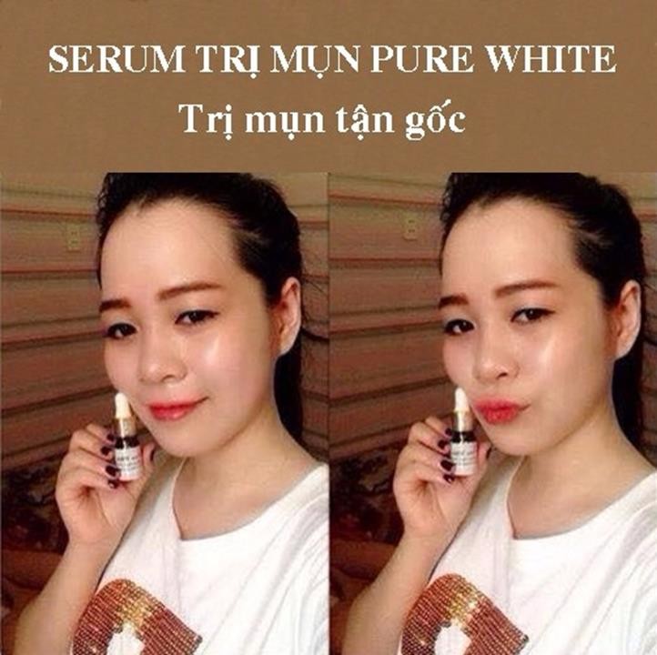 SERUM TRỊ MỤN PURE WHITE 3