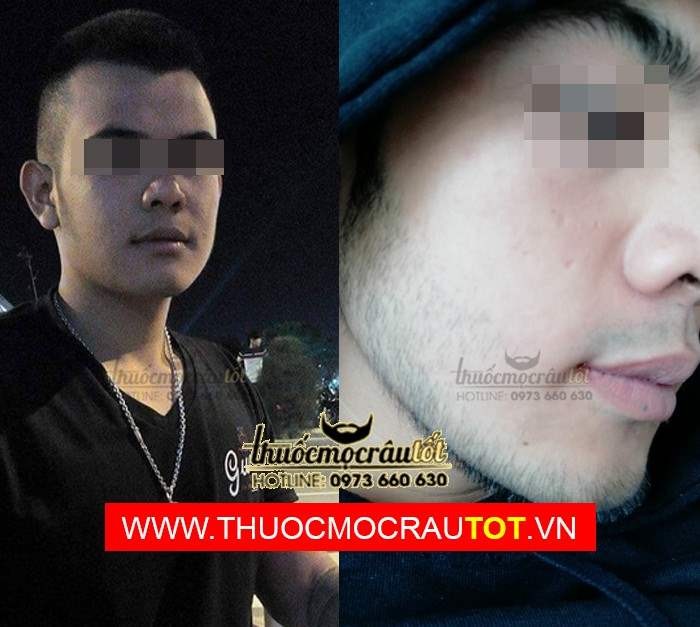 Thuốc mọc râu minoxidil 5 dạng bọt