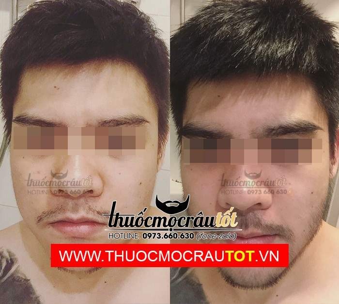 Thuốc mọc râu minoxidil 5 dạng bọt