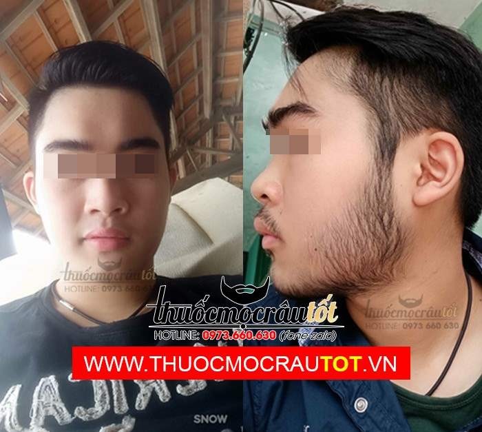 Thuốc mọc râu minoxidil 5 dạng bọt