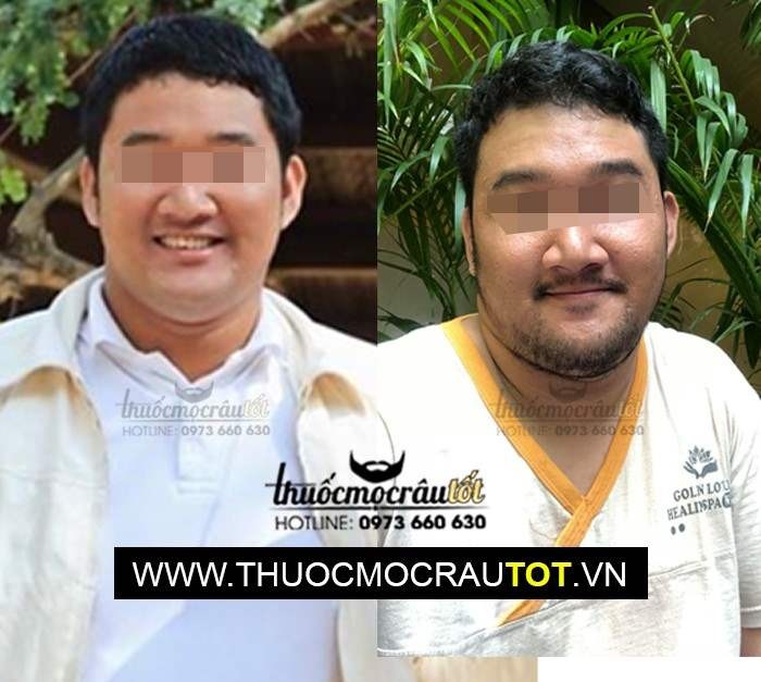 Thuốc mọc râu minoxidil 5 dạng bọt