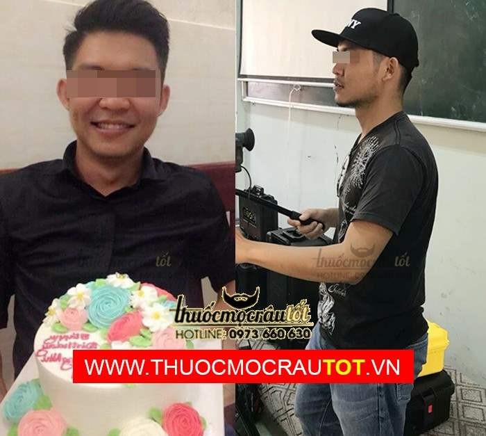 Thuốc mọc râu minoxidil 5 dạng bọt