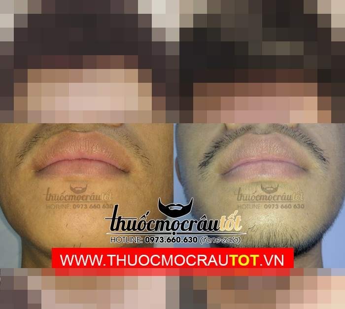 Thuốc mọc râu minoxidil 5 dạng bọt