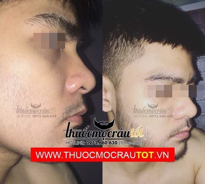 Thuốc mọc râu minoxidil 5 dạng bọt
