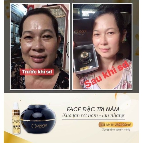 KEM FACE ĐẶT TRỊ NÁM QUEENIE SKIN