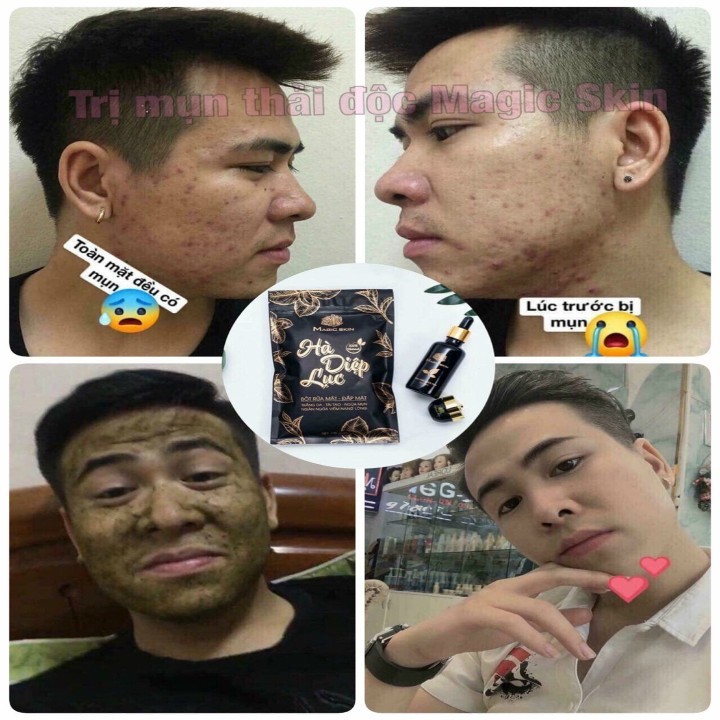 Tinh chất trị mụn Magic Skin