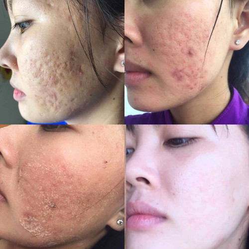 THẢO DƯỢC TRỊ MỤN NÁM NGỌC LINH SÂM