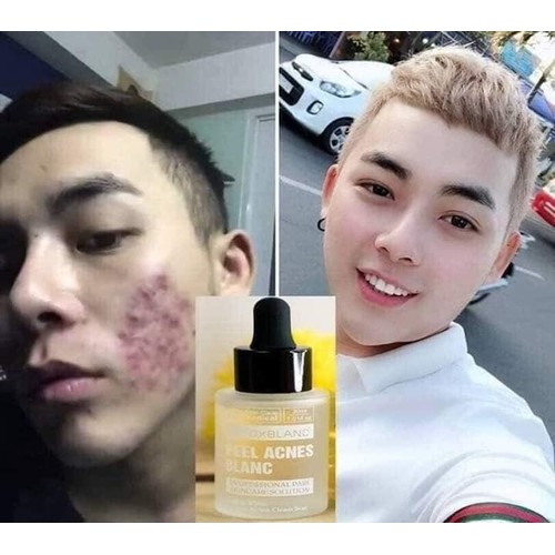SERUM PEEL DETOX BLANC 2 LOẠI ĐẶC TRỊ MỤN VÀ ĐẶC TRỊ NÁM