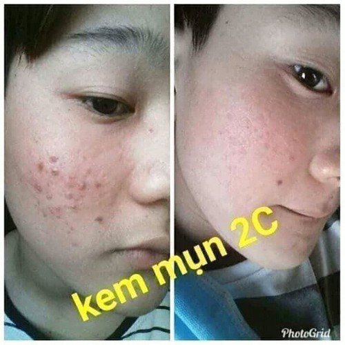 kem trị mụn 2c