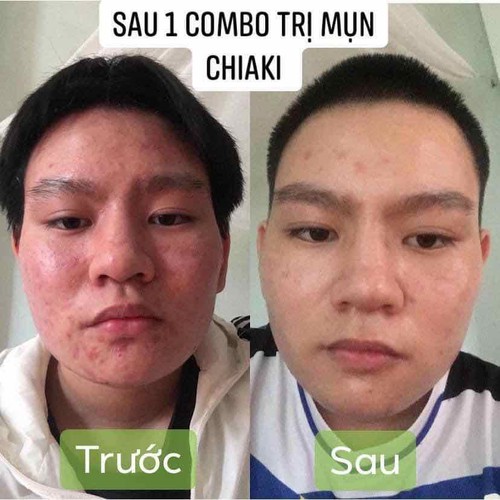 Combo 2 kem thuốc bắc trị mụn thuốc Bắc Chi's