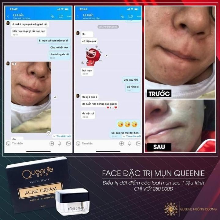 Kem Đặc Trị Mụn Queenie Skin