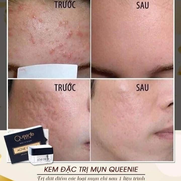 Kem Đặc Trị Mụn Queenie Skin