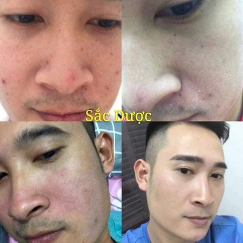 SẮC DƯỢC ĐÔNG Y CHUYÊN TRỊ MỤN
