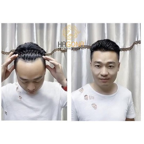 Tóc mái hói nam chữ M 100% tóc thật