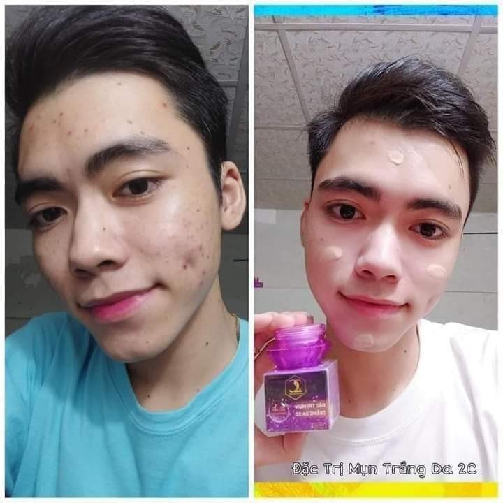 KEM TRI MỤN 2C-TRẮNG DA