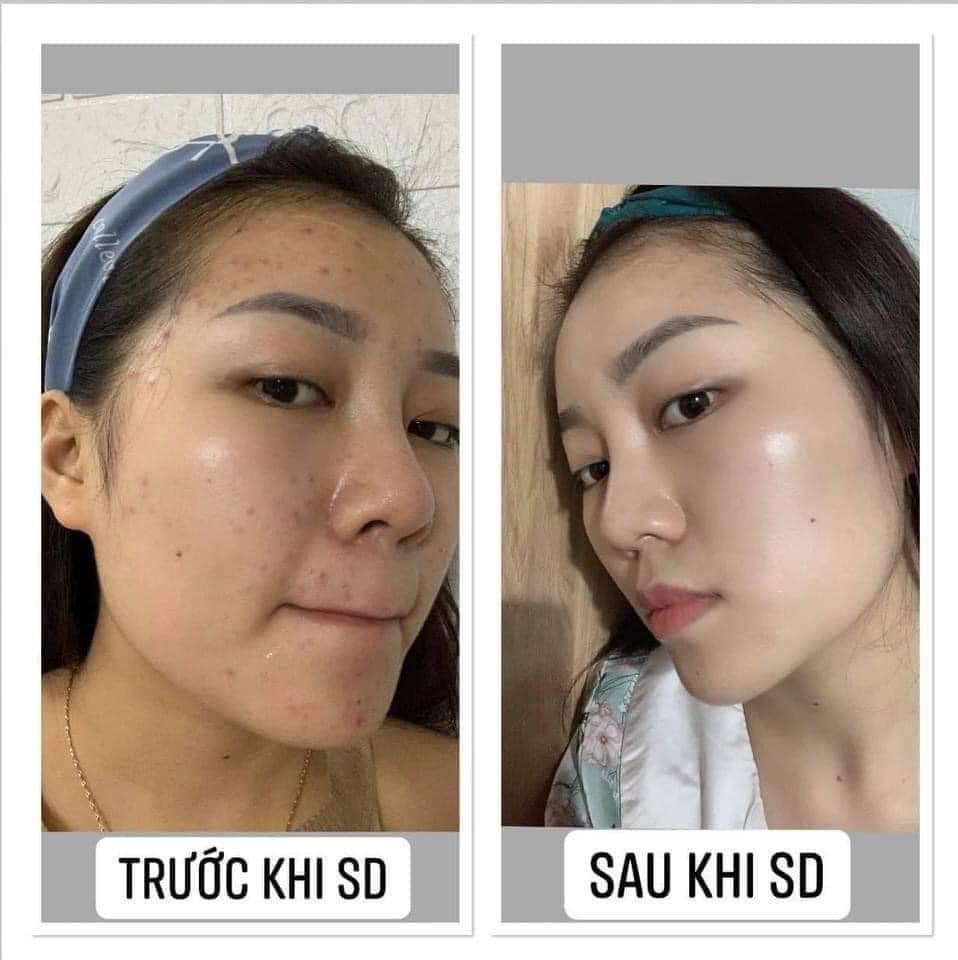 Chuối thải chì, trị thâm Detox zenpali