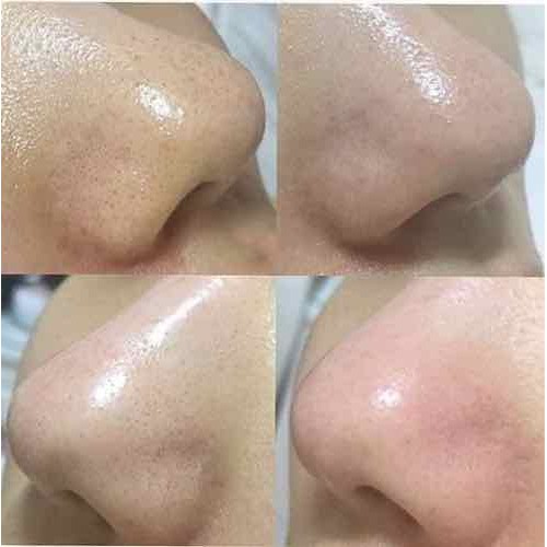 Dung Dịch Ủ Đẩy Mụn Đầu Đen MEDIPEEL EXTRA SUPER 9 COMPLEX