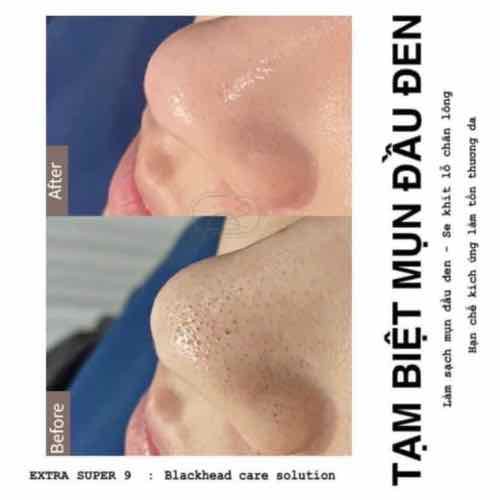 Dung Dịch Ủ Đẩy Mụn Đầu Đen MEDIPEEL EXTRA SUPER 9 COMPLEX