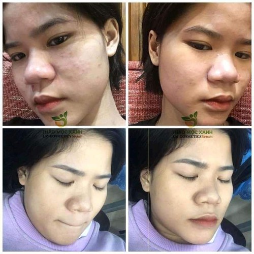 Thảo Mộc Xanh Combo