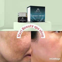 combo siêu trị nám MH Beauty